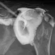 Arthrographie de l'épaule