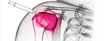 Arthrodistension