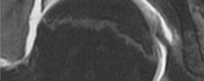 Arthro-IRM